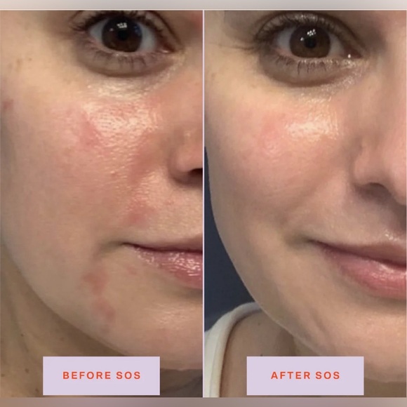 New SOS Tower 28 Daily Rescue Facial Spray - Spray Protecteur for Skin Flare-Ups - Picture 3 of 13